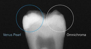 Venus Pearl One (Kulzer)