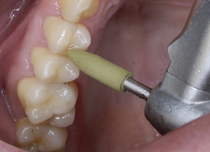 CompoMaster CA/FG Fin/Pol Kit #0331 (Shofu)