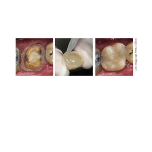 ETC Easy Temporary Cement 5ml Syringe (Parkell)