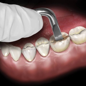 Goldstein Crown Remover Occlusal Surface (HuFiedy)