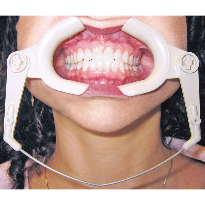 Cheek Retractor High Heat Wire Type
